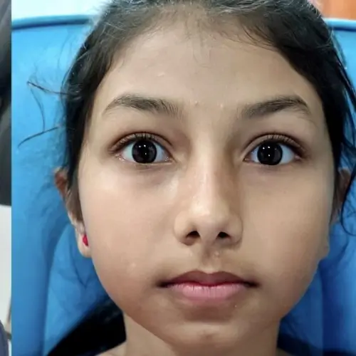After squint (strabismus) treatment — improved alignment, second clinical example