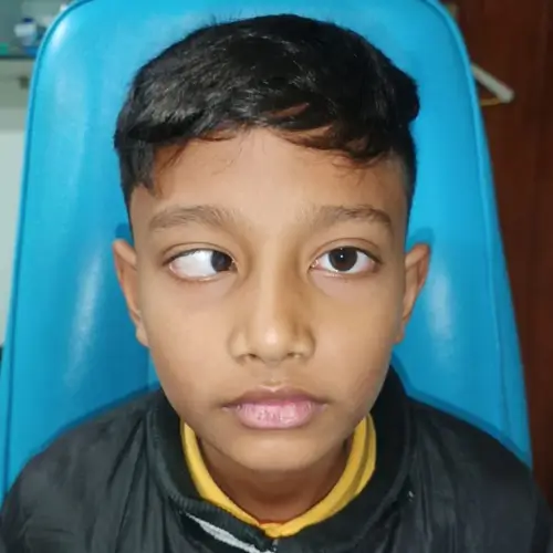 Before squint (strabismus) treatment — clinical photograph of eye alignment