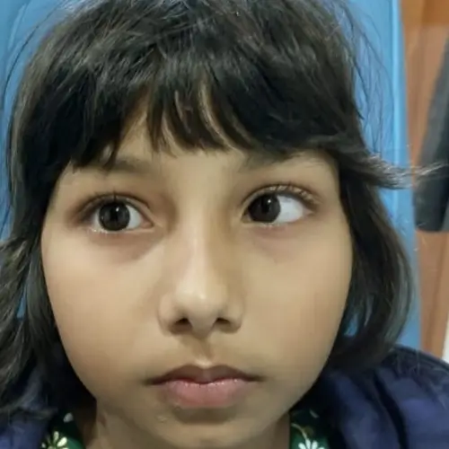 Before squint (strabismus) treatment — second clinical example, eye alignment