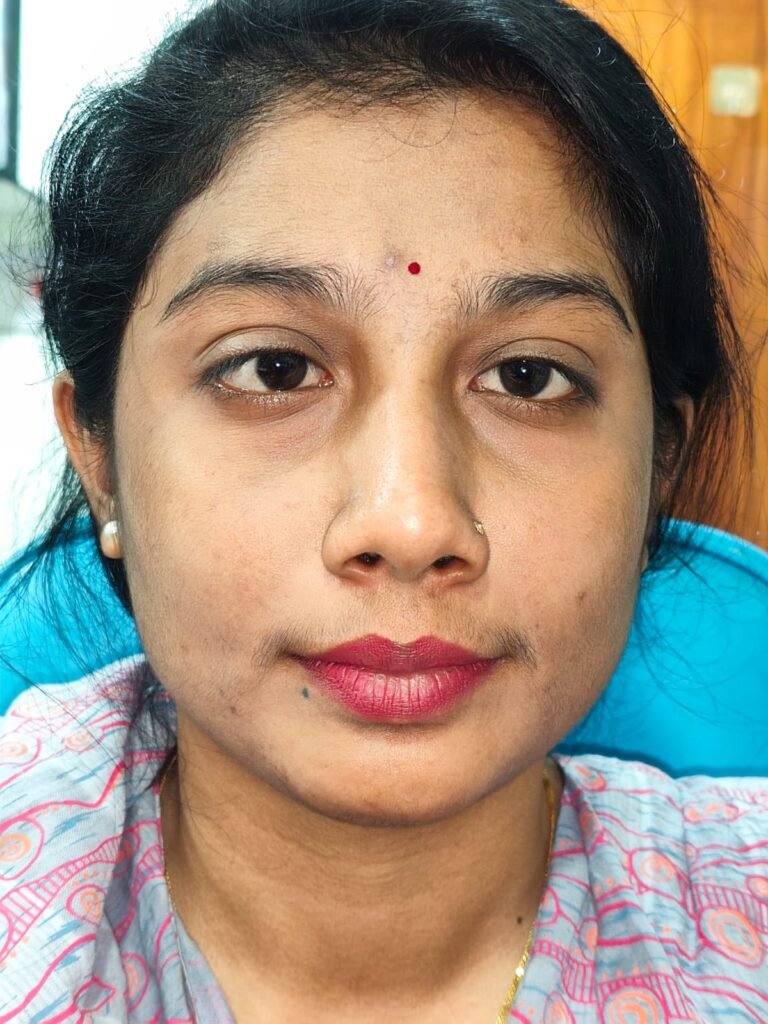Squint - Dr. Md. Salahuddin Rahmatullah Shaheen Professional Gallery